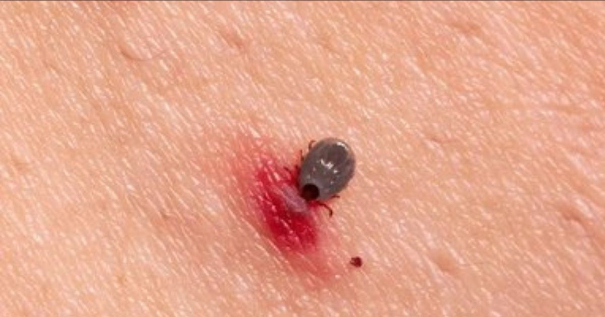 CDC Reports Surge in Lyme Disease Cases Across US